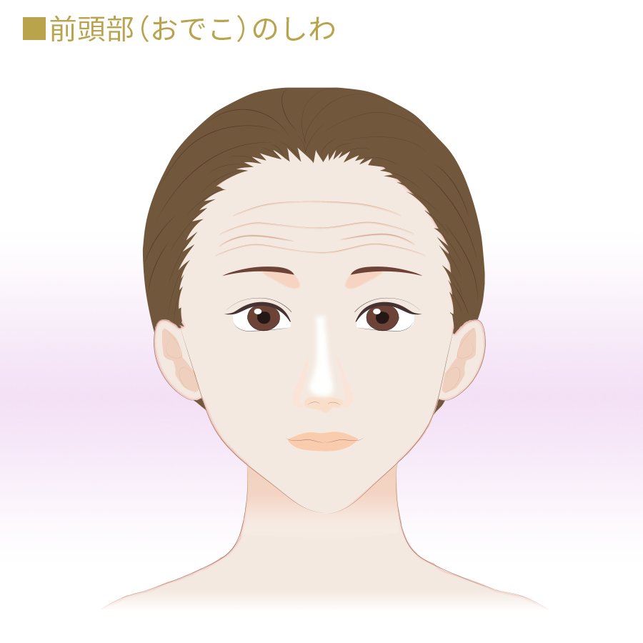 前頭部(おでこ)のしわ改善ボトックス