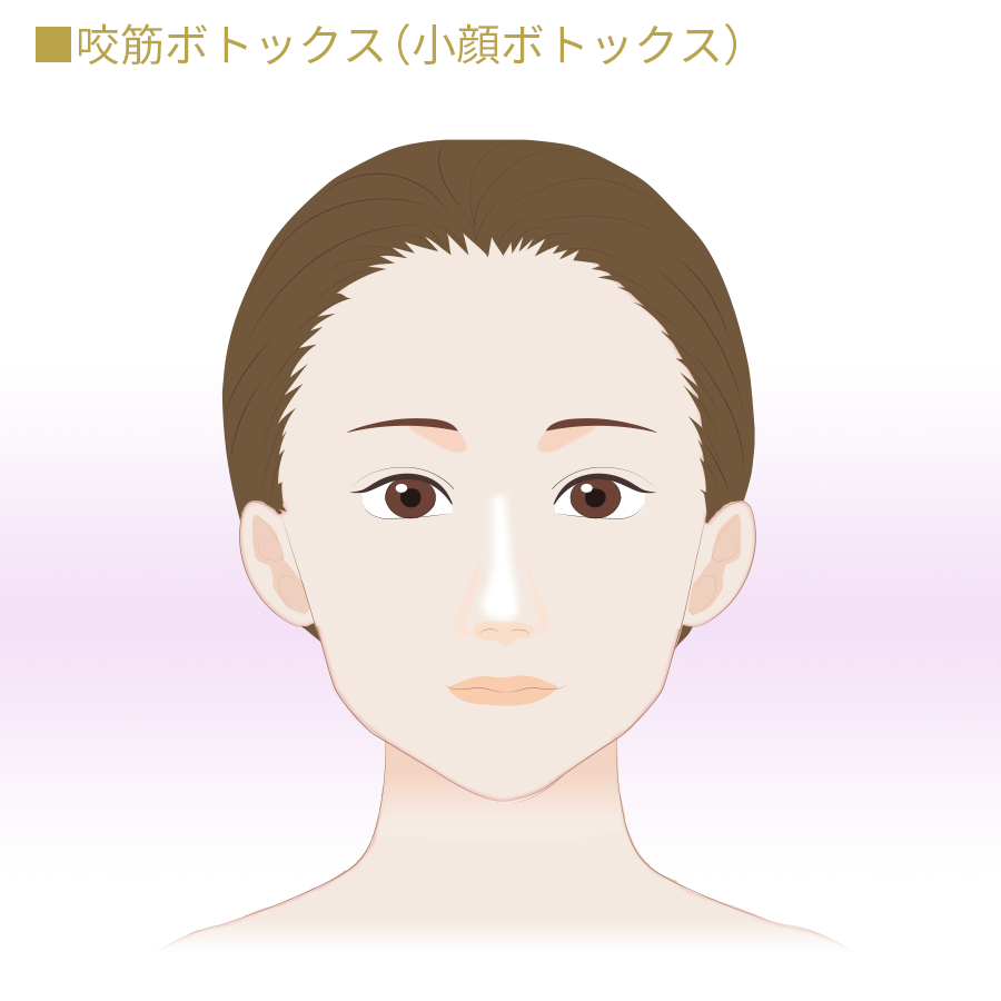 咬筋ボトックス(小顔ボトックス)