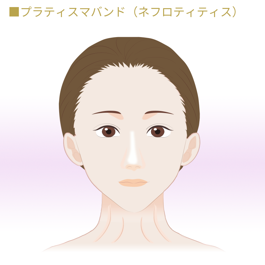 プラティスマバンド(ネフロティティス)のボトックス治療