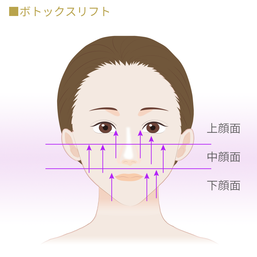 ボトックスリフト