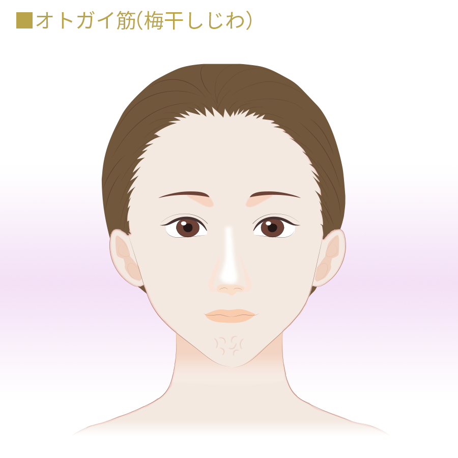 オトガイ筋(梅干しじわ)改善ボトックス