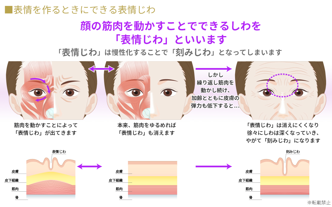 表情じわ