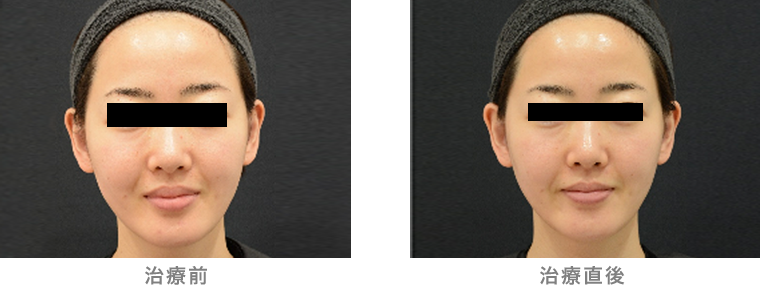 症例 コラーゲンピール