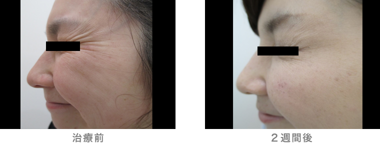 30代女性症例写真(ボトックス注入)