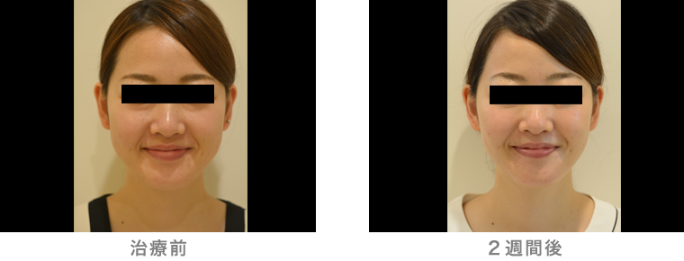 20代女性症例写真(ボトックス注入)