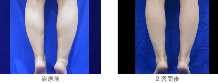 30代 女性症例写真(ボトックス注入)